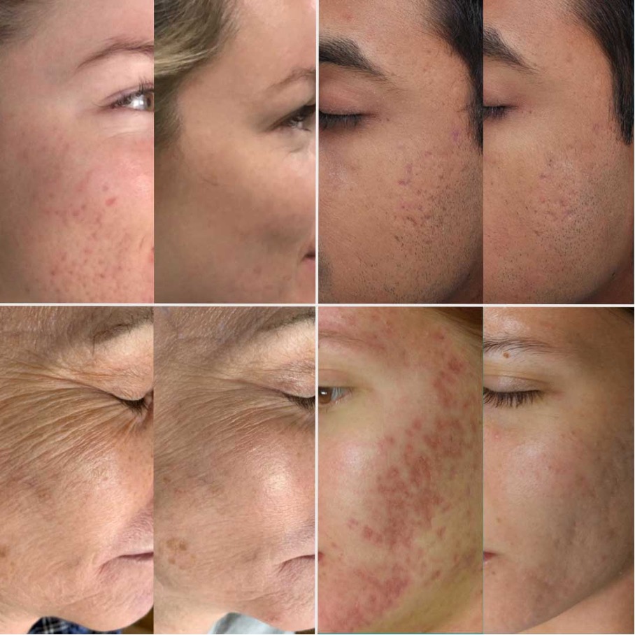 Vergleich vorher/nachher Microneedling